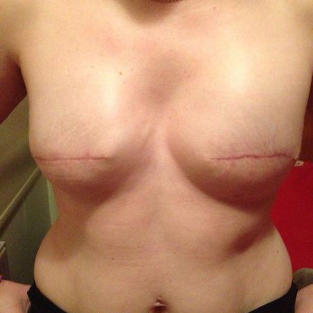 Breast With No Nipples 65